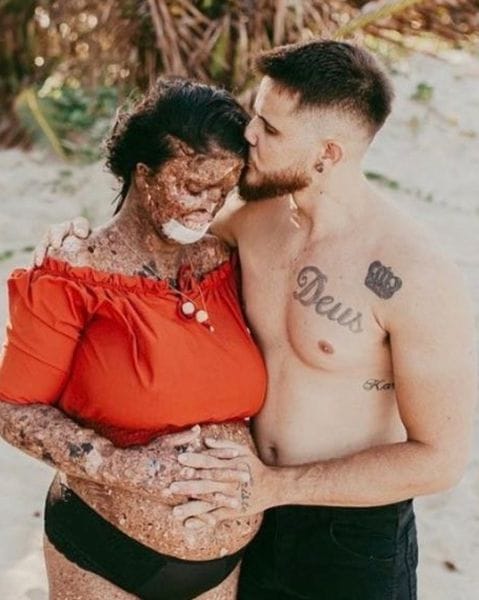 HT2. Woman with rare skin condition overcomes negativity and finds true love