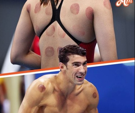 HT4. Why Were Olympic Athletes & Other Celebs Spotted with Dark Red Circles on Their Bodies?