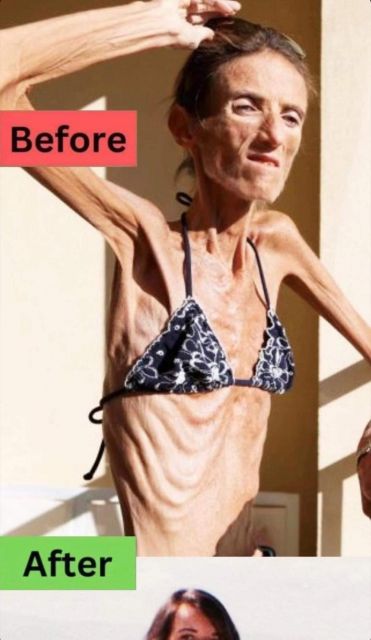 ST1. The World’s Thinnest Woman’s Battle Against Anorexia Will Leave You Speechless!