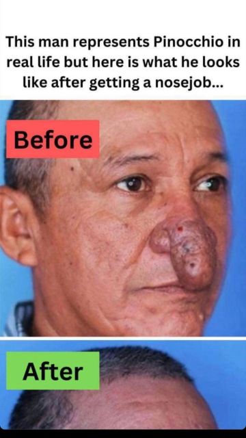 ST4. The Remarkable Transformation of Conrado’s Nose S2