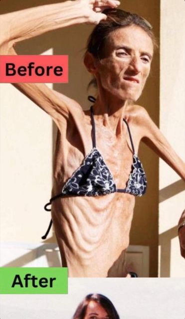 ST6.The World’s Thinnest Woman’s Battle Against Anorexia Will Leave You Speechless!