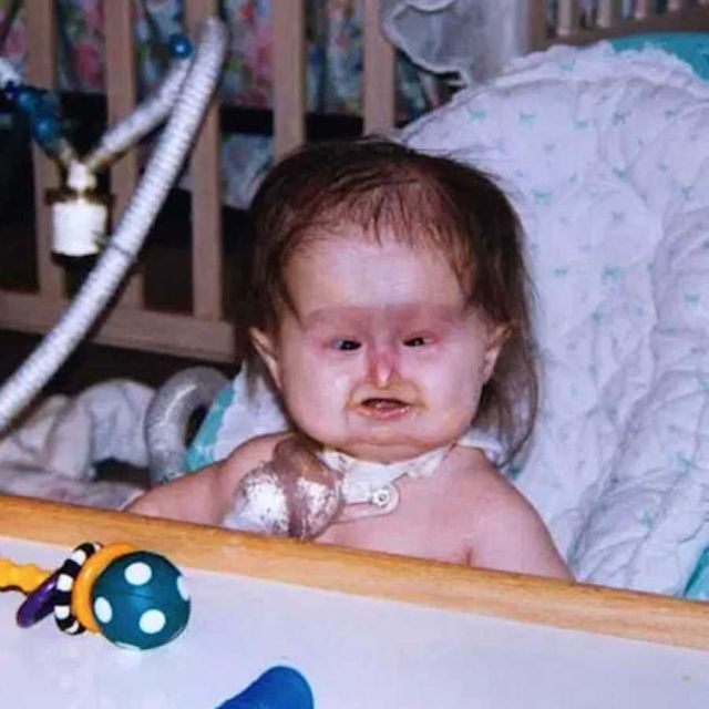 HT1. Baby Born With Unusual Syndrome – 22 Years Later She Looks Amazing